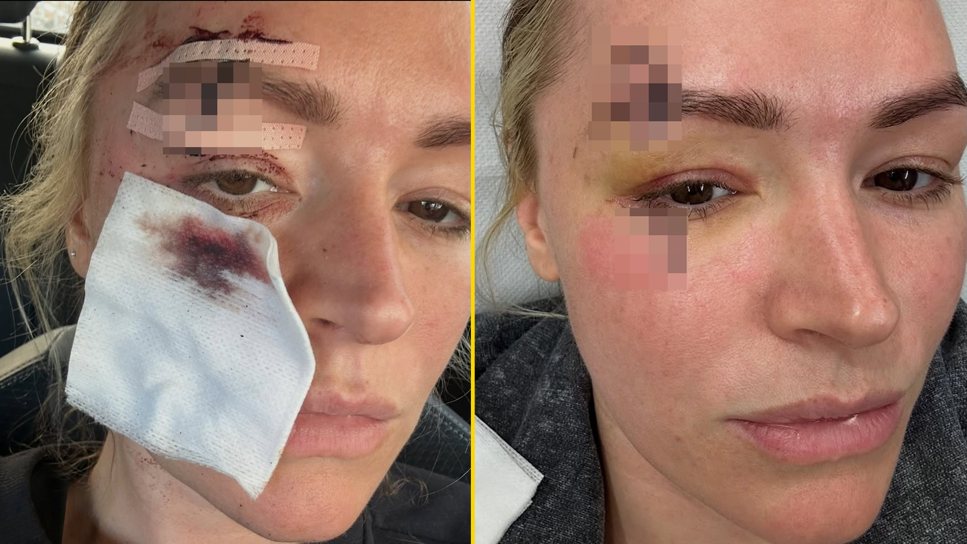 “如果你膽怯就不要看”——勞拉·伍茲分享恐怖燈罩事故的圖片