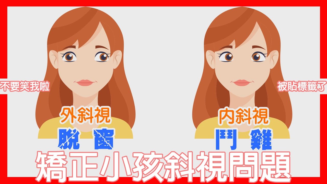 Lác mắt là gì? Nguyên nhân và cách điều trị lác mắt | Nobel Eye Care